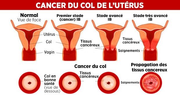 Symptome du cancer du col de l uterus